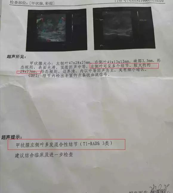 甲状腺结节ti-rads3类可以自愈吗,甲状腺结节ti-rads3类能自愈吗