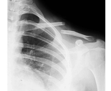 锁骨是保守治疗好还是手术治疗好,锁骨保守治疗好还是手术好