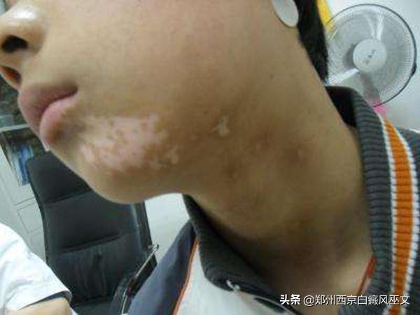 白癜风治好后皮肤可以恢复原样吗,白癜风可以治愈吗儿童