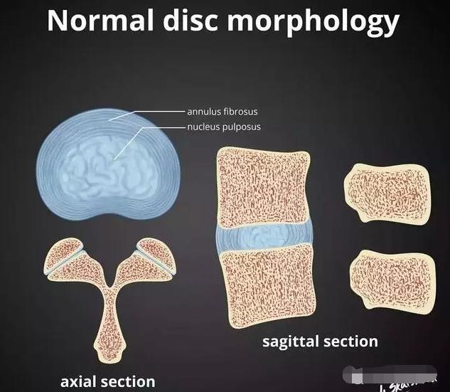腰椎间盘的膨出和突出有什么区别,腰椎间盘膨出和突出有什么区别