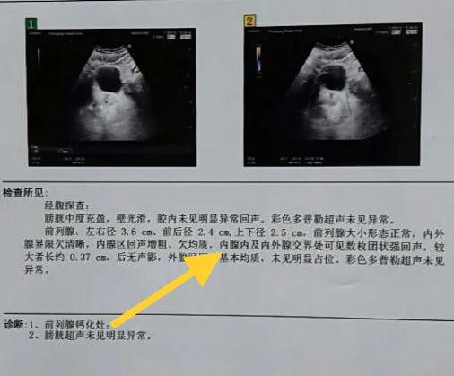 前列腺钙化灶可以用冲击波治疗吗,前列腺钙化灶尿频尿痛怎么治疗