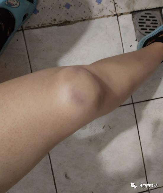 溜冰摔倒了膝盖不能弯曲,溜冰摔倒膝盖肿了怎么办