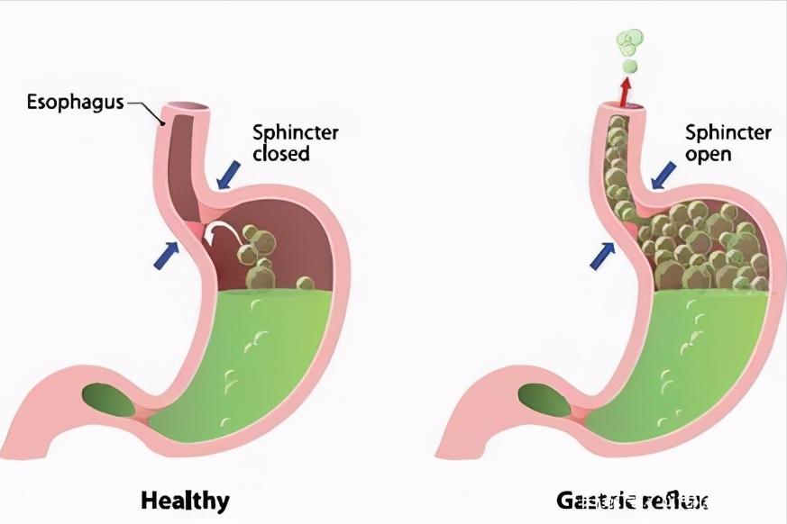 小苏打碳酸氢钠有毒吗,痛风可以喝含碳酸氢钠的苏打水吗