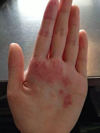 惹上牛皮癣这个大佬，脱发也来敲你的门？