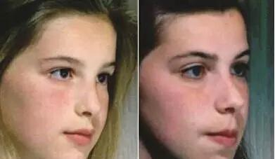 孩子张嘴呼吸如何纠正,孩子喜欢张嘴有什么影响