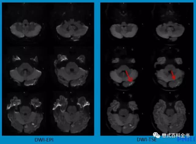 dwi成像序列,dwi序列和edwi序列