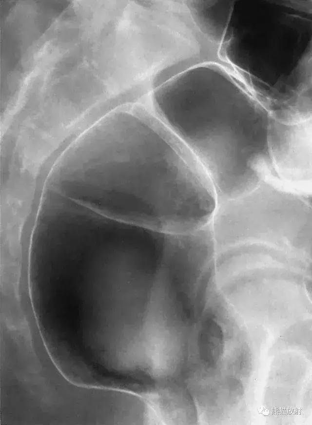 「收藏」11种消化道造影解剖图谱