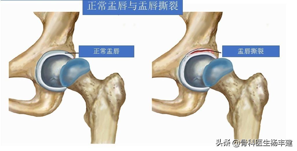 老年人常见的髋部损伤有哪些,跑步的常见损伤之髋关节