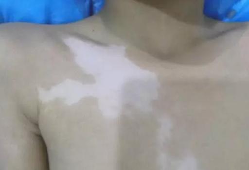 不看不知道，原来你患的是神经节段型白癜风