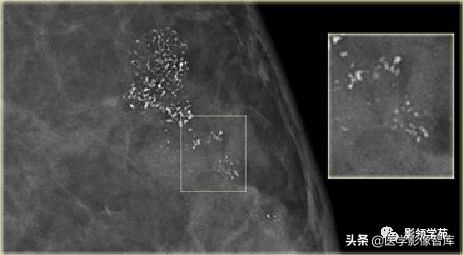 乳腺钙化怎么区分良性和恶性,乳腺钙化的诊断与分级