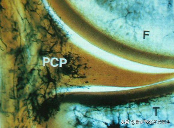 韦德的半月板撕裂到什么程度,韦德半月板损伤