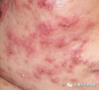 看懂各种痘痘类型和应对方法,一分钟教你分辨痘痘类型