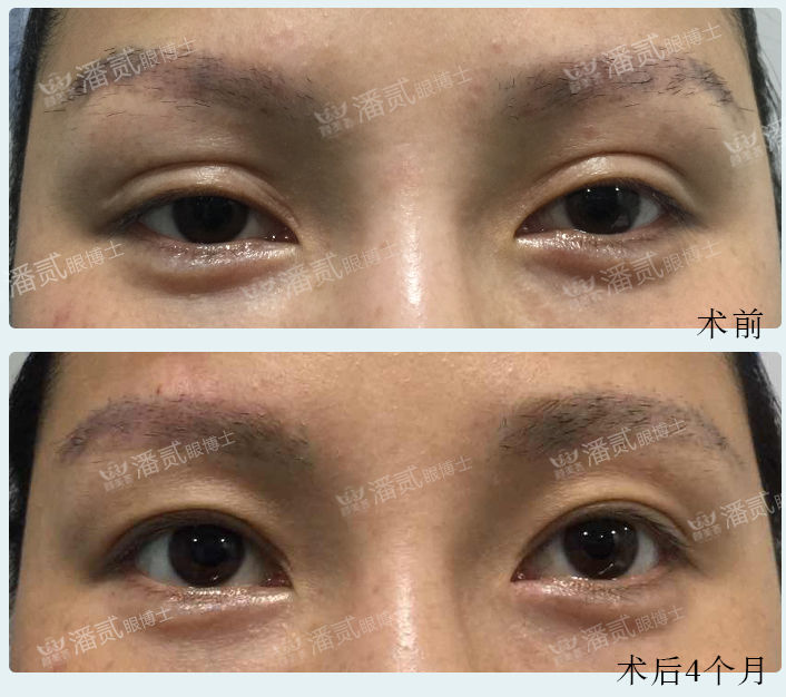 双眼皮手术科普：割双眼皮七大常见误区，您中招了几个？