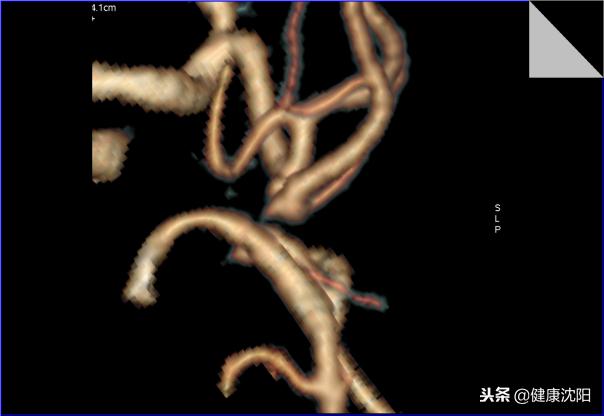 cta和血管造影怎么选择,血管oct检查与血管造影检查的区别