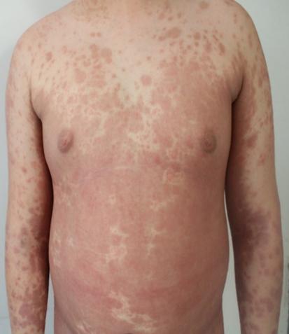 女儿得了银屑病怎么办,宝宝湿疹和银屑病区别