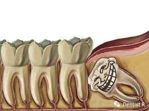 拔智齿能治脸歪吗,科普拔了智齿真的可以瘦脸吗