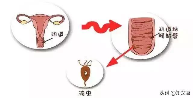 女生们都来了解滴虫性阴道炎，教你如何知道患上了滴虫性阴道炎
