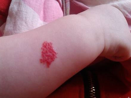 婴儿有胎记如何确认是红瘤,宝宝生下来的胎记