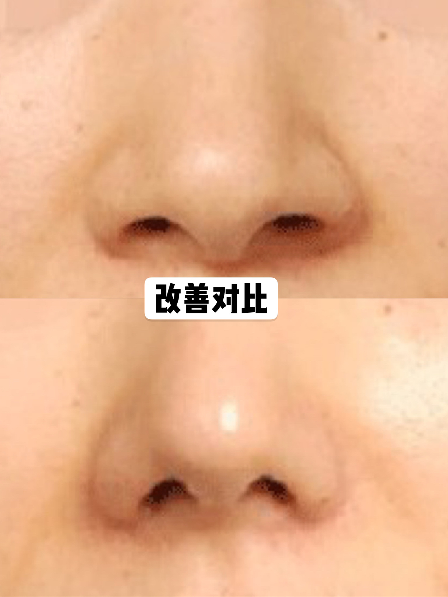 鼻翼缩小可以单独做吗,内切鼻翼缩小有效果吗