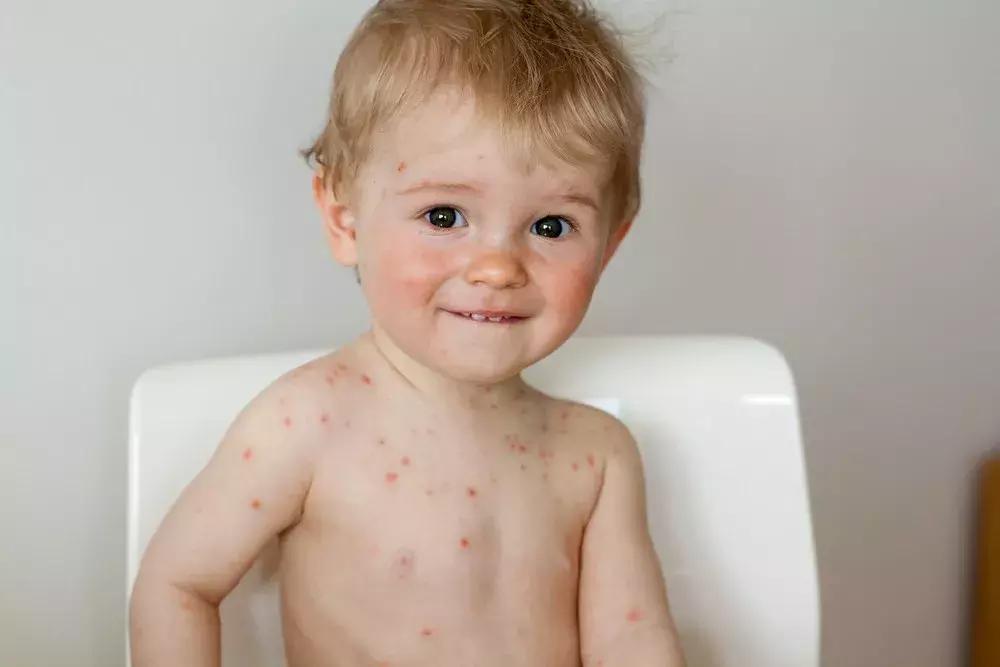 麻疹水痘最快治疗方法,麻疹风疹水痘