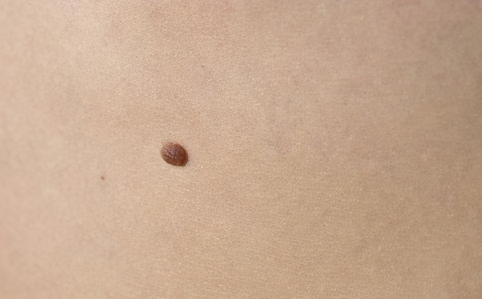 身上的痣发生癌变的症状,莫名其妙的痣可能是癌症信号