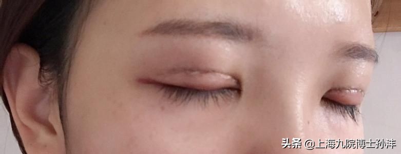 后天自然形成的双眼皮,怎么粘双眼皮贴才自然