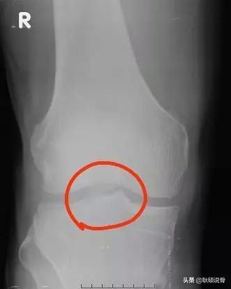 类风湿性关节炎手掌长有骨刺咋办,关节长骨刺一定是创伤性关节炎吗