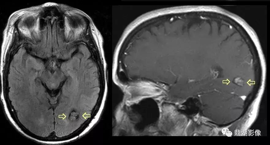 颅内海绵状血管瘤的增强影像,脑内海绵状血管瘤影像表现