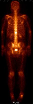 前列腺癌转移骨髓瘤治愈经验,前列腺癌骨转移抗癌成功案例