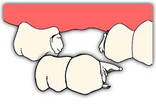 单颗牙缺失搭桥牢固吗,单颗槽牙缺失修复选用哪种方法好