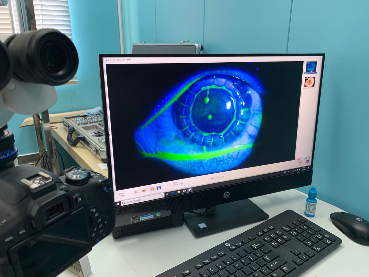 新郎视力下降竟是角膜病变，无锡医生妙手回春