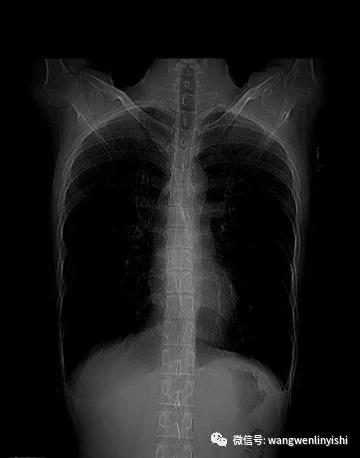 扁平型胸部,扁平胸部