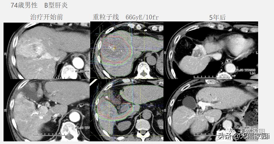 质子治疗手术适合大型肿瘤,肿瘤不能根治吗