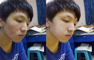 长期长痘的原因和解决方法,很少长痘23岁开始长痘什么原因