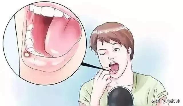 口腔溃疡黄色和白色哪个严重,口腔溃疡一面白色一面黄色的药