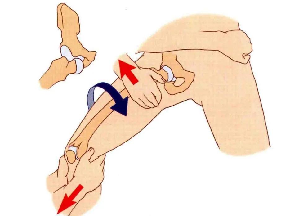 髋关节脱位闭合复位方法,髋关节脱位复位治疗过程