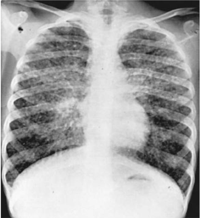 结节病关节痛眼睛模糊,结节病引起的关节炎