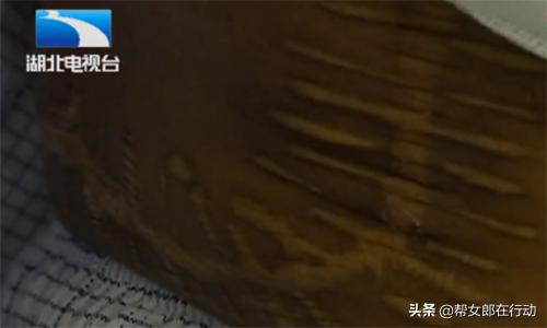 男子实习被半挂撞伤，肝移植需花70万，肇事者：我没钱能咋办