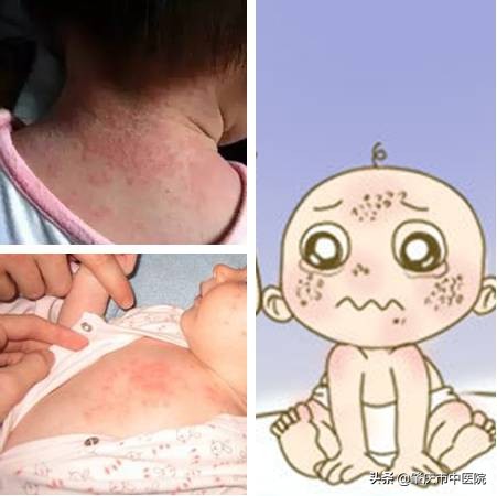 解读八种夏天易发皮肤病,冬季高发四类皮肤病该如何预防