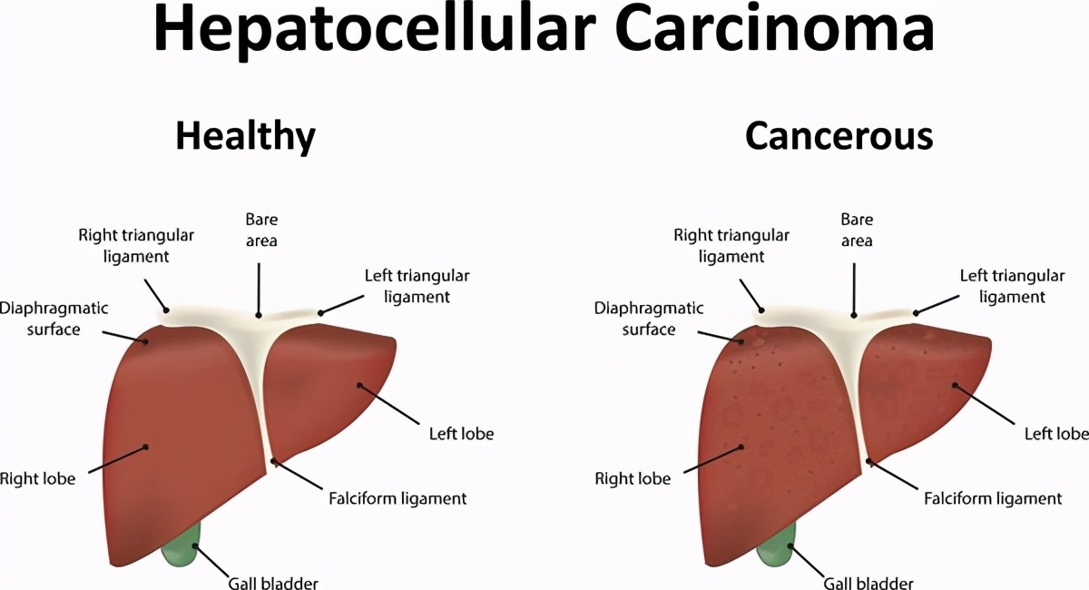 肝癌出现腹水肚子胀意味着什么,弥漫性肝癌晚期怎么解决腹胀腹水