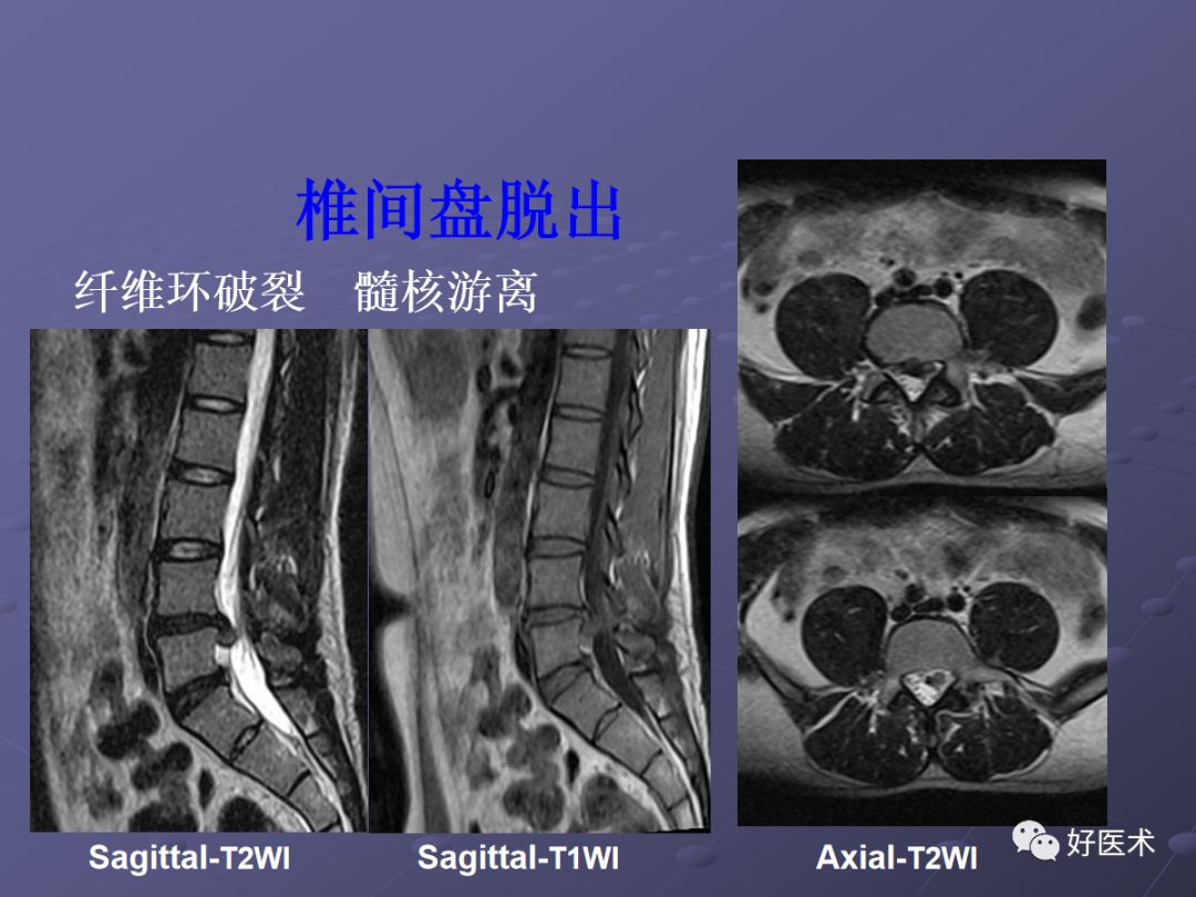 脊柱mri有哪些特点,乳腺疾病的mri诊断及鉴别