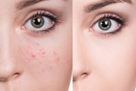 抖音别来无恙,痘印走开对付痘印的正确方法