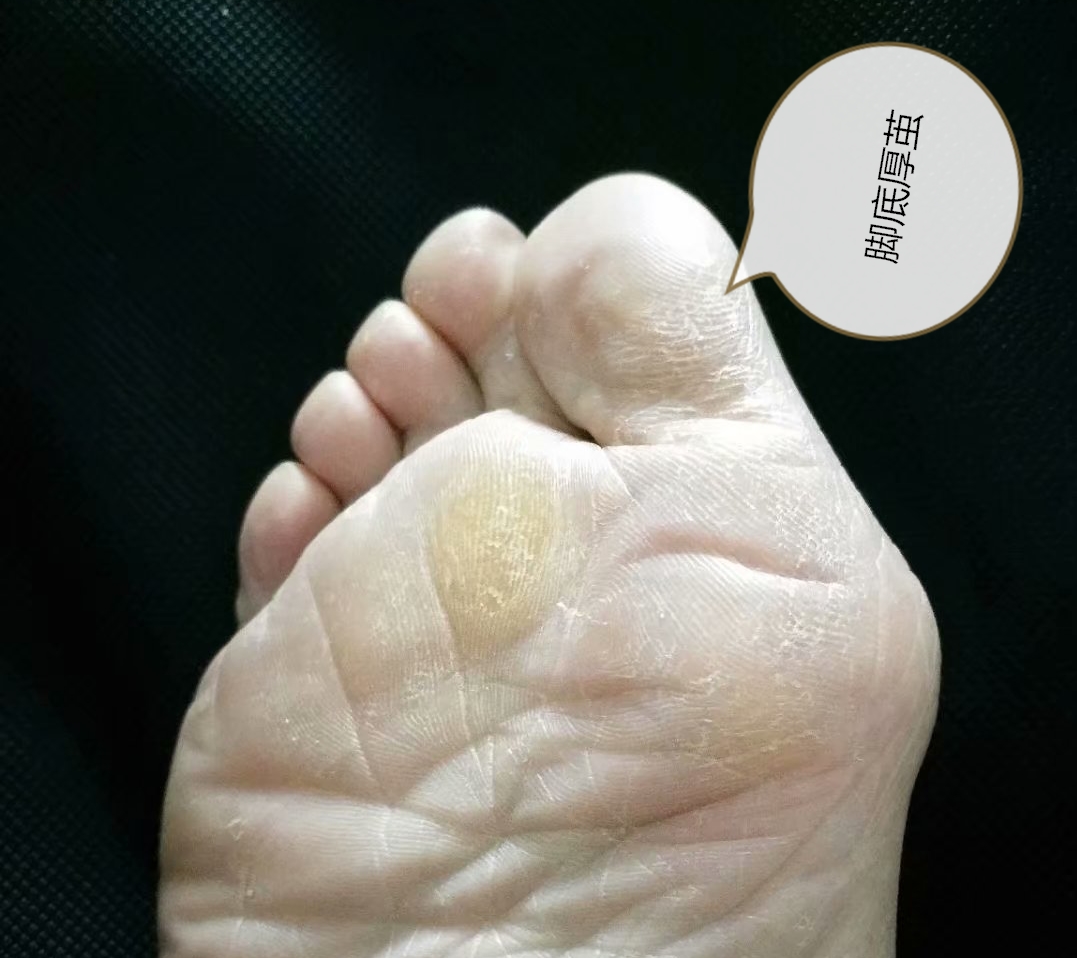 大脚趾外翻有什么可以治疗的,大脚趾外翻后遗症