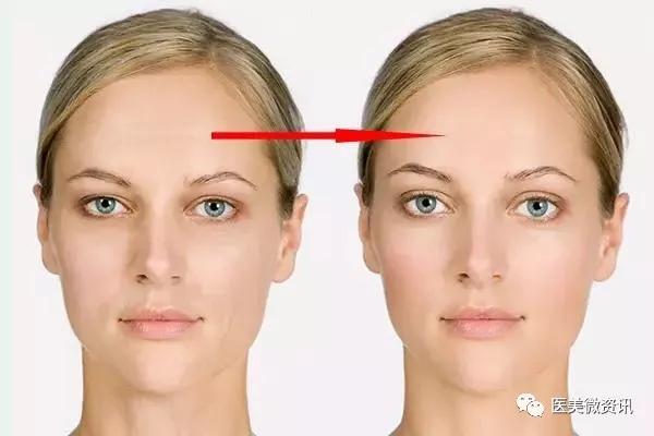 肉毒素怎么去皱原理是什么,肉毒素眼部祛皱多久打一次