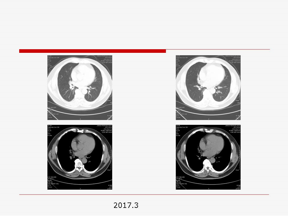 像炎症的肺癌能治好吗,医生说可能是肺癌也可能是炎症