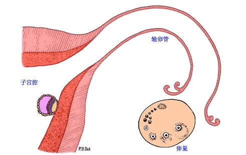 宫外孕保守治疗后成功怀孕案例,宫外孕3个月后再次宫外孕怎么办