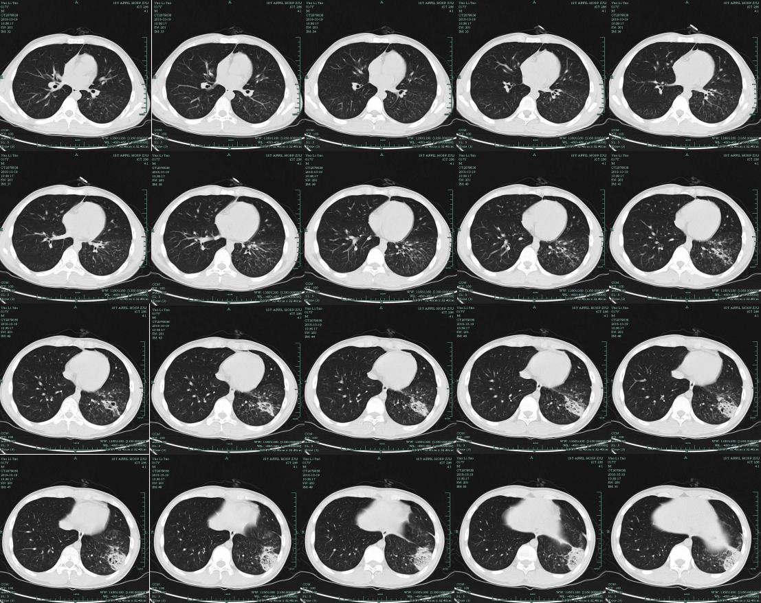 mngs病原检测的优势,mngs真的可靠吗