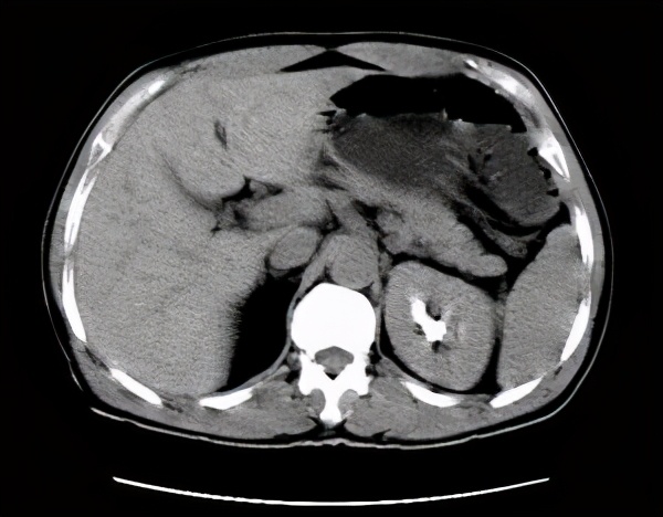 肾中度积水怎么治疗能彻底治好吗,老人双肾积水的保守治疗