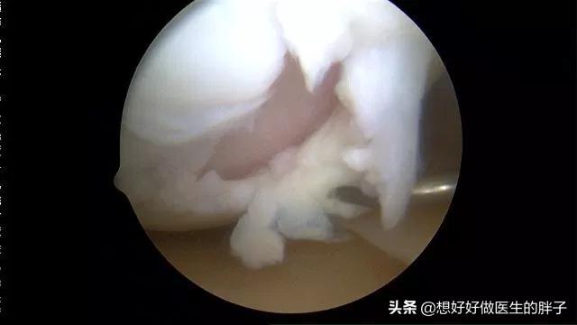 走路膝盖会突然软一下就骨折,走路时膝盖突然软一下怎么治