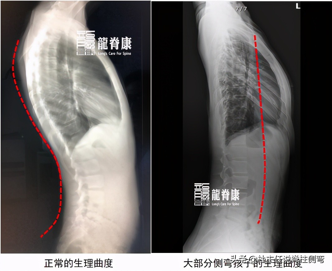 儿童脊柱侧弯单杠矫正正确姿势,脊柱侧弯拉单杠好还是吊单杠好